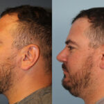 rhinoplasty-merged-1