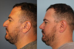 before and after rhinoplasty