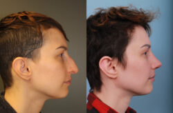 before and after rhinoplasty