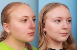 before and after rhinoplasty