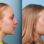 rhinoplasty-merged-16