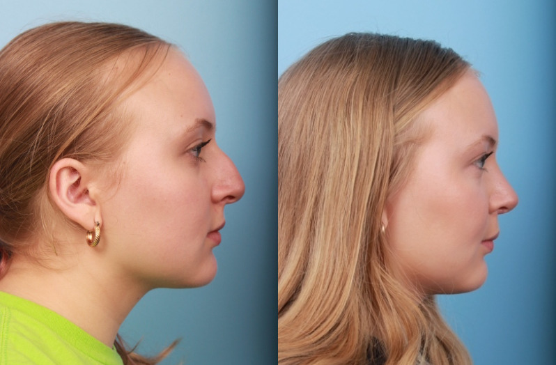 before_after_img
