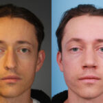rhinoplasty-merged-17