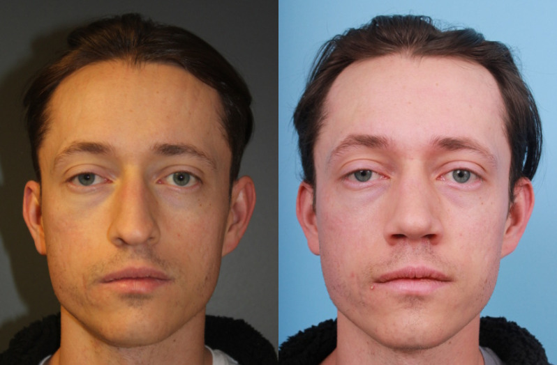 before_after_img