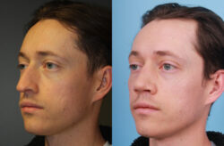 before and after rhinoplasty