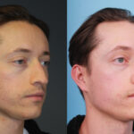 rhinoplasty-merged-19