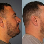 rhinoplasty-merged-2