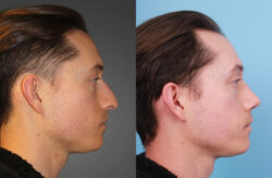 before and after rhinoplasty