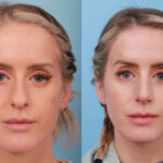 rhinoplasty-merged-21