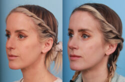 before and after rhinoplasty