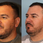 rhinoplasty-merged-3
