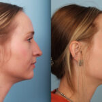 rhinoplasty-merged-6