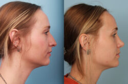 before and after rhinoplasty