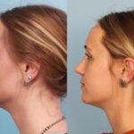 rhinoplasty-merged-7