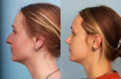 before and after rhinoplasty