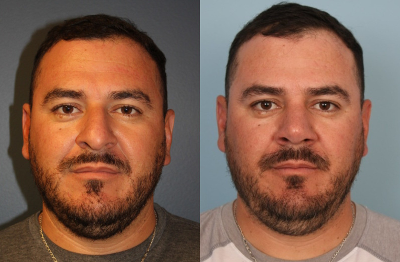 before_after_img