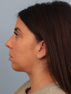 after rhinoplasty