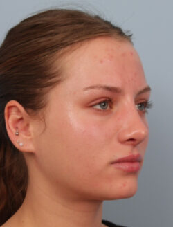 after rhinoplasty