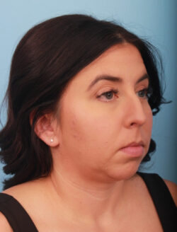 before rhinoplasty