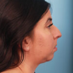 rhinoplasty-before-3