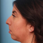 rhinoplasty-before-4