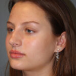 rhinoplasty-before-5