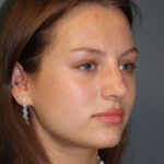 rhinoplasty-before-6