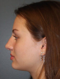 before rhinoplasty