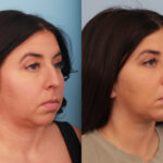 rhinoplasty-merged-1