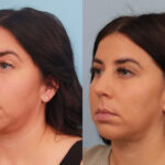 rhinoplasty-merged-2