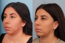 before and after rhinoplasty