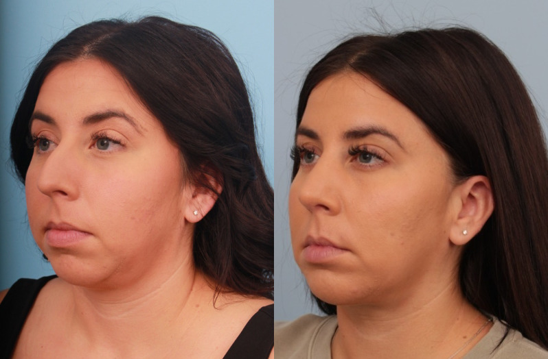 before_after_img