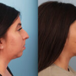 rhinoplasty-merged-3