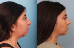 before and after rhinoplasty