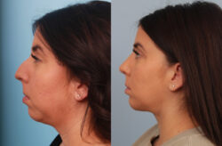 before and after rhinoplasty