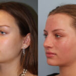 rhinoplasty-merged-5