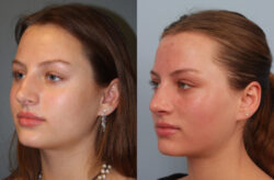 before and after rhinoplasty