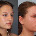 rhinoplasty-merged-6
