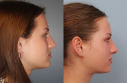 before and after rhinoplasty