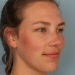 rhinoplasty-after-1