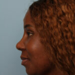 rhinoplasty-after-8