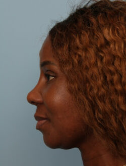 after rhinoplasty