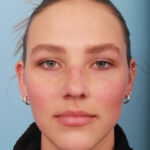 rhinoplasty-before