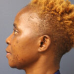 rhinoplasty-before-8