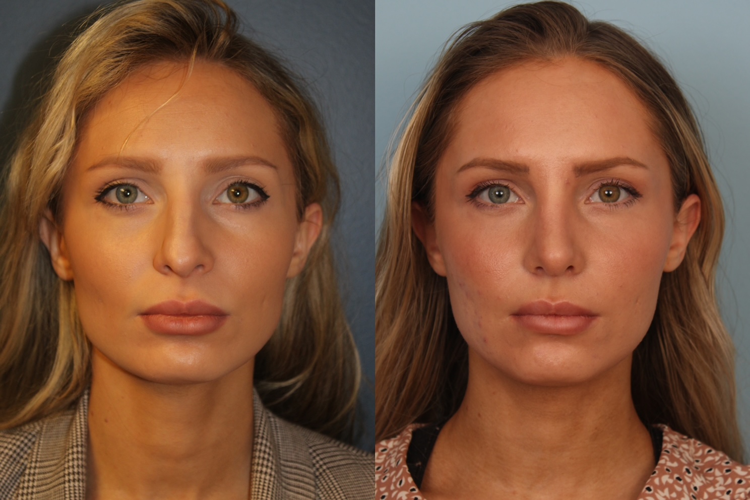 before_after_img