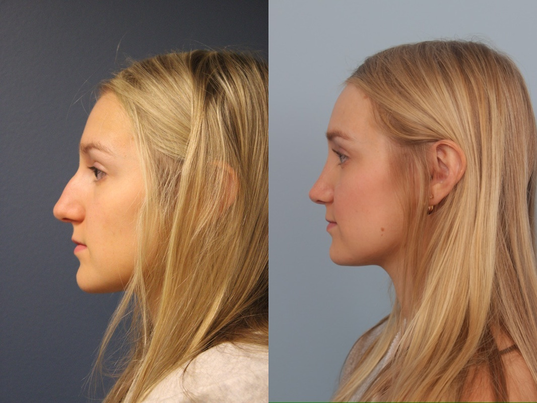 before_after_img