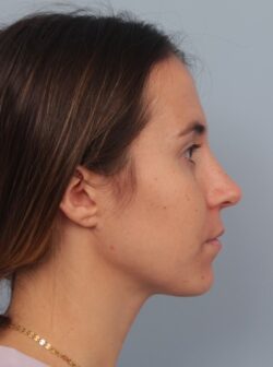 after rhinoplasty