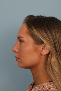 after rhinoplasty
