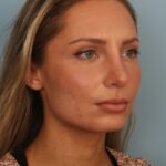 rhinoplasty-after-12