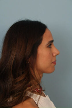 after rhinoplasty